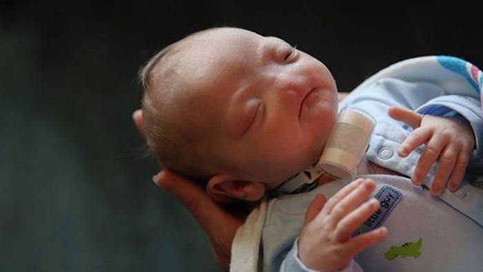 Burunsuz Doğan Bebeğin Binlerce Facebook Takipçisi Var galerisi resim 2